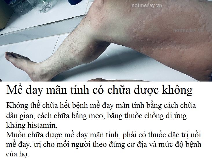 Mề đay mãn tính có chữa được không